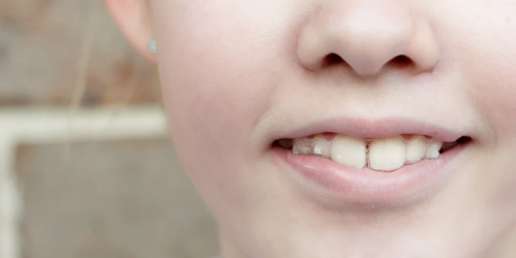 Dientes grandes en tus hijos ¿Qué hacer? 2 dientes grandes