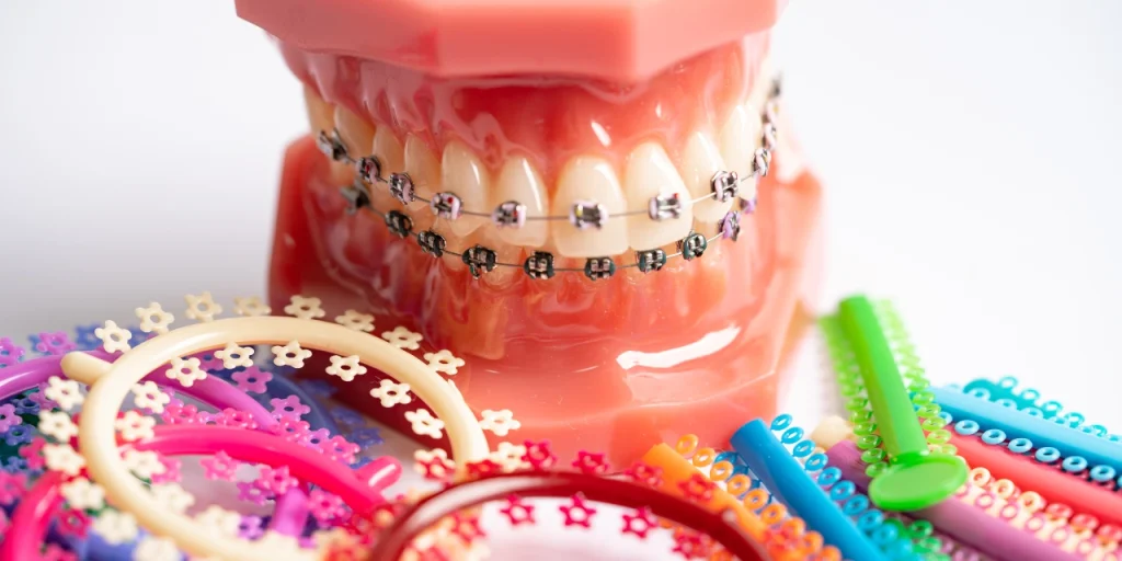 ¿Cuánto dura un tratamiento ortodóncico? 2 tratamiento ortodóncico